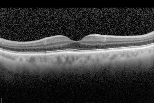 Macroaneurysm - Resolved without treatment
87 year old female with vision loss OD.  Initial FA showed no leakage so no treatment was done and the fluid absorbed over 4 months.  Initial VA 20/100, Final VA 20/80

