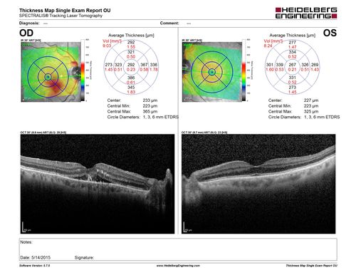 Macroaneurysm - Resolved without treatment
87 year old female with vision loss OD.  Initial FA showed no leakage so no treatment was done and the fluid absorbed over 4 months.  Initial VA 20/100, Final VA 20/80

