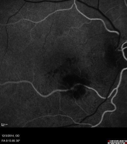 Macroaneurysm - Resolved without treatment
87 year old female with vision loss OD.  Initial FA showed no leakage so no treatment was done and the fluid absorbed over 4 months.  Initial VA 20/100, Final VA 20/80
