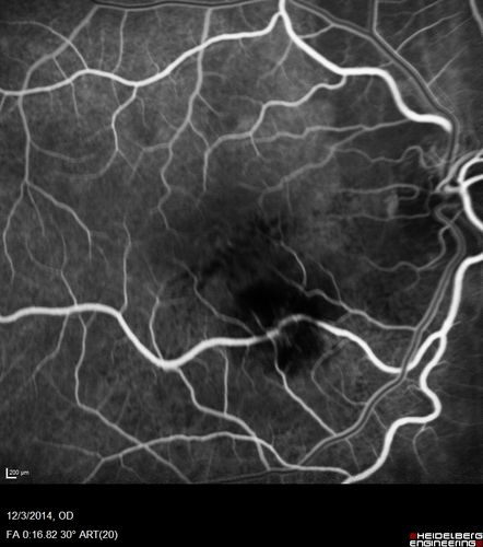 Macroaneurysm - Resolved without treatment
87 year old female with vision loss OD.  Initial FA showed no leakage so no treatment was done and the fluid absorbed over 4 months.  Initial VA 20/100, Final VA 20/80
