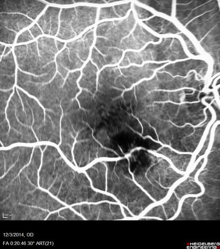Macroaneurysm - Resolved without treatment
87 year old female with vision loss OD.  Initial FA showed no leakage so no treatment was done and the fluid absorbed over 4 months.  Initial VA 20/100, Final VA 20/80

