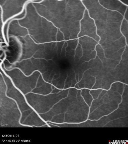 Macroaneurysm - Resolved without treatment
87 year old female with vision loss OD.  Initial FA showed no leakage so no treatment was done and the fluid absorbed over 4 months.  Initial VA 20/100, Final VA 20/80
