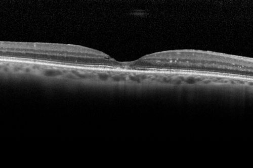 Macroaneurysm - Resolved without treatment
87 year old female with vision loss OD.  Initial FA showed no leakage so no treatment was done and the fluid absorbed over 4 months.  Initial VA 20/100, Final VA 20/80
