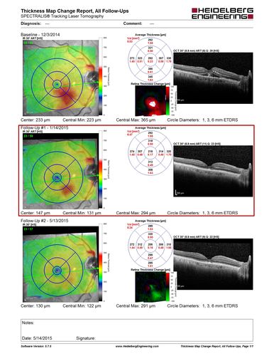 Macroaneurysm - Resolved without treatment
87 year old female with vision loss OD.  Initial FA showed no leakage so no treatment was done and the fluid absorbed over 4 months.  Initial VA 20/100, Final VA 20/80
