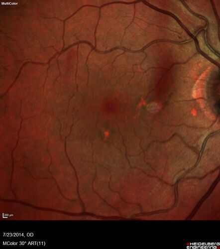 Retinal Arterial  Macroaneurysm treated with Laser
89 year old female with peripapillary CNVM treated with Lucentis. Vision was 20/25 OS 3 weeks ago.  She noticed vision loss OS.  Vision had dropped to 20/60.  She had a fresh MA and was treated with laser.
