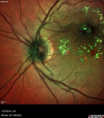 Retinal Arterial  Macroaneurysm treated with Laser
89 year old female with peripapillary CNVM treated with Lucentis. Vision was 20/25 OS 3 weeks ago.  She noticed vision loss OS.  Vision had dropped to 20/60.  She had a fresh MA and was treated with laser.
