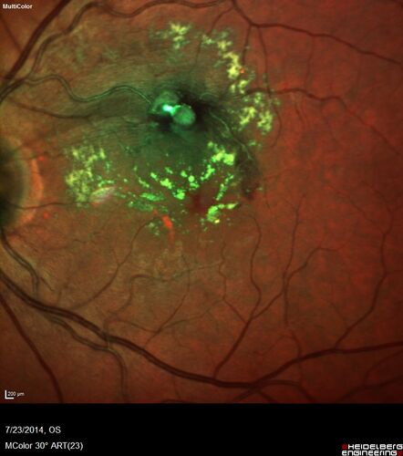 Retinal Arterial  Macroaneurysm treated with Laser
89 year old female with peripapillary CNVM treated with Lucentis. Vision was 20/25 OS 3 weeks ago.  She noticed vision loss OS.  Vision had dropped to 20/60.  She had a fresh MA and was treated with laser.
