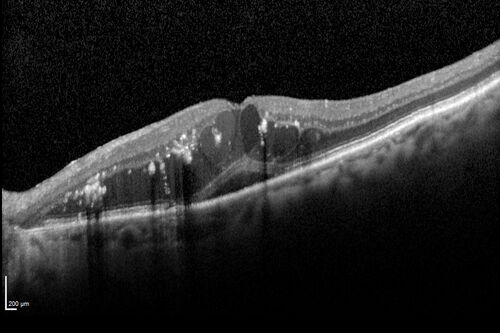 Retinal Arterial  Macroaneurysm treated with Laser
89 year old female with peripapillary CNVM treated with Lucentis. Vision was 20/25 OS 3 weeks ago.  She noticed vision loss OS.  Vision had dropped to 20/60.  She had a fresh MA and was treated with laser.
