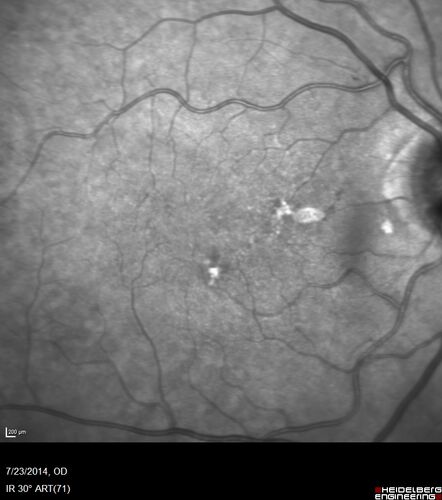 Retinal Arterial  Macroaneurysm treated with Laser
89 year old female with peripapillary CNVM treated with Lucentis. Vision was 20/25 OS 3 weeks ago.  She noticed vision loss OS.  Vision had dropped to 20/60.  She had a fresh MA and was treated with laser.
