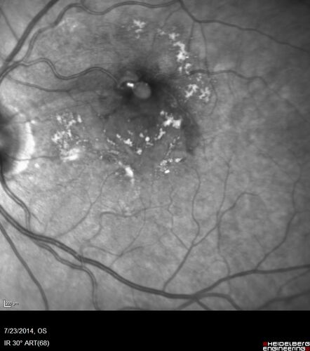 Retinal Arterial  Macroaneurysm treated with Laser
89 year old female with peripapillary CNVM treated with Lucentis. Vision was 20/25 OS 3 weeks ago.  She noticed vision loss OS.  Vision had dropped to 20/60.  She had a fresh MA and was treated with laser.

