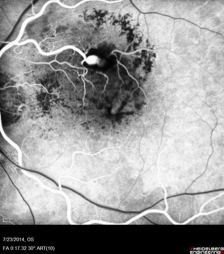 Retinal Arterial  Macroaneurysm treated with Laser
89 year old female with peripapillary CNVM treated with Lucentis. Vision was 20/25 OS 3 weeks ago.  She noticed vision loss OS.  Vision had dropped to 20/60.  She had a fresh MA and was treated with laser.
