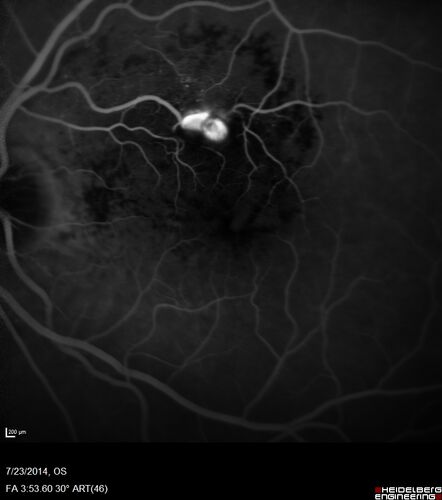 Retinal Arterial  Macroaneurysm treated with Laser
89 year old female with peripapillary CNVM treated with Lucentis. Vision was 20/25 OS 3 weeks ago.  She noticed vision loss OS.  Vision had dropped to 20/60.  She had a fresh MA and was treated with laser.
