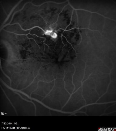 Retinal Arterial  Macroaneurysm treated with Laser
89 year old female with peripapillary CNVM treated with Lucentis. Vision was 20/25 OS 3 weeks ago.  She noticed vision loss OS.  Vision had dropped to 20/60.  She had a fresh MA and was treated with laser.
