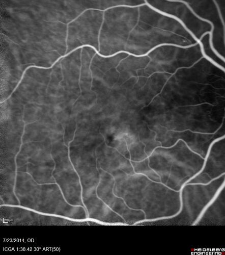 Retinal Arterial  Macroaneurysm treated with Laser
89 year old female with peripapillary CNVM treated with Lucentis. Vision was 20/25 OS 3 weeks ago.  She noticed vision loss OS.  Vision had dropped to 20/60.  She had a fresh MA and was treated with laser.
