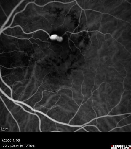 Retinal Arterial  Macroaneurysm treated with Laser
89 year old female with peripapillary CNVM treated with Lucentis. Vision was 20/25 OS 3 weeks ago.  She noticed vision loss OS.  Vision had dropped to 20/60.  She had a fresh MA and was treated with laser.
