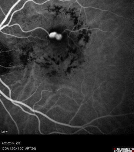 Retinal Arterial  Macroaneurysm treated with Laser
89 year old female with peripapillary CNVM treated with Lucentis. Vision was 20/25 OS 3 weeks ago.  She noticed vision loss OS.  Vision had dropped to 20/60.  She had a fresh MA and was treated with laser.
