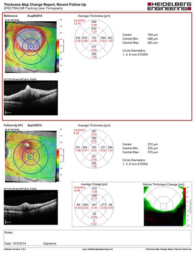 Retinal Arterial  Macroaneurysm treated with Laser
89 year old female with peripapillary CNVM treated with Lucentis. Vision was 20/25 OS 3 weeks ago.  She noticed vision loss OS.  Vision had dropped to 20/60.  She had a fresh MA and was treated with laser.
