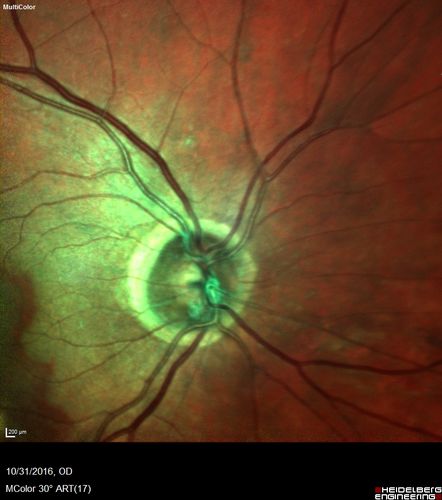 Submacular Hemorrhage - wet AMD
84 year old man with 20/200 from submacular hemorrhage.  Vision improved to 20/32 with only Avastin therapy (no surgical intervention).  The initial FAF is interesting because parts of the blood hyper auto fluoresce.
