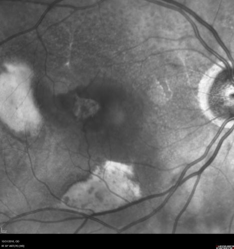 Submacular Hemorrhage - wet AMD
84 year old man with 20/200 from submacular hemorrhage.  Vision improved to 20/32 with only Avastin therapy (no surgical intervention).  The initial FAF is interesting because parts of the blood hyper auto fluoresce.
