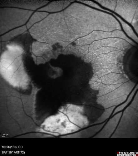 Submacular Hemorrhage - wet AMD
84 year old man with 20/200 from submacular hemorrhage.  Vision improved to 20/32 with only Avastin therapy (no surgical intervention).  The initial FAF is interesting because parts of the blood hyper auto fluoresce.

