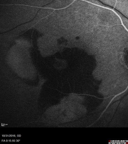 Submacular Hemorrhage - wet AMD
84 year old man with 20/200 from submacular hemorrhage.  Vision improved to 20/32 with only Avastin therapy (no surgical intervention).  The initial FAF is interesting because parts of the blood hyper auto fluoresce.
