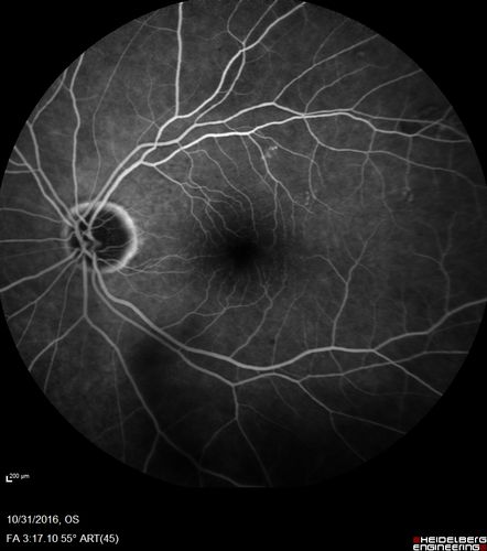 Submacular Hemorrhage - wet AMD
84 year old man with 20/200 from submacular hemorrhage.  Vision improved to 20/32 with only Avastin therapy (no surgical intervention).  The initial FAF is interesting because parts of the blood hyper auto fluoresce.

