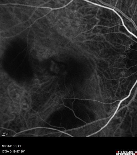 Submacular Hemorrhage - wet AMD
84 year old man with 20/200 from submacular hemorrhage.  Vision improved to 20/32 with only Avastin therapy (no surgical intervention).  The initial FAF is interesting because parts of the blood hyper auto fluoresce.
