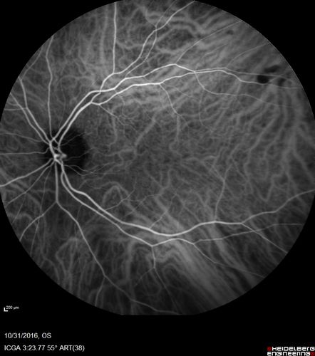 Submacular Hemorrhage - wet AMD
84 year old man with 20/200 from submacular hemorrhage.  Vision improved to 20/32 with only Avastin therapy (no surgical intervention).  The initial FAF is interesting because parts of the blood hyper auto fluoresce.
