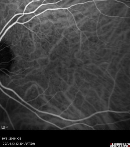 Submacular Hemorrhage - wet AMD
84 year old man with 20/200 from submacular hemorrhage.  Vision improved to 20/32 with only Avastin therapy (no surgical intervention).  The initial FAF is interesting because parts of the blood hyper auto fluoresce.
