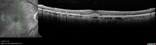 Submacular Hemorrhage - wet AMD
84 year old man with 20/200 from submacular hemorrhage.  Vision improved to 20/32 with only Avastin therapy (no surgical intervention).  The initial FAF is interesting because parts of the blood hyper auto fluoresce.
