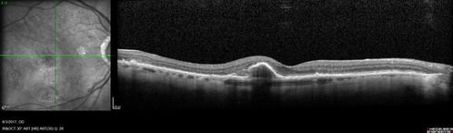 Submacular Hemorrhage - wet AMD
84 year old man with 20/200 from submacular hemorrhage.  Vision improved to 20/32 with only Avastin therapy (no surgical intervention).  The initial FAF is interesting because parts of the blood hyper auto fluoresce.
