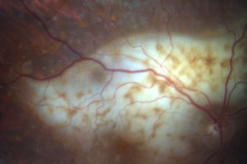 Primary Ocular Lymphoma - Lesion has grown in size over 3 months
