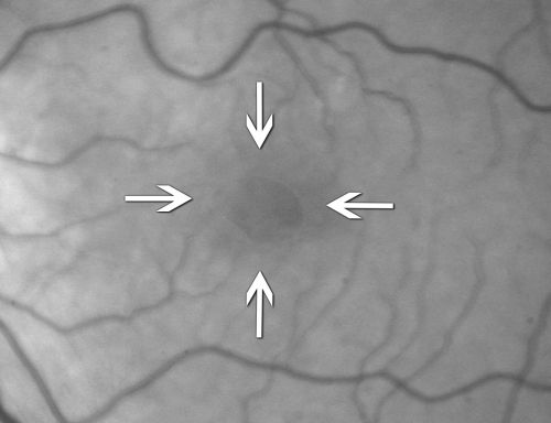Partial PVD - Posterior Hyaloid Gap Over Center of Macula
This image illustraites how sometimes, when the posterior vitreous separates from the retina, a small area of vitreous is left behind.  One theory holds that macular puckers can form from that left behind vitreous
