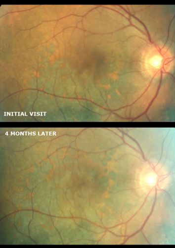 Pigmented Choroidal Mass Right Eye - Melanoma vs. Nevus vs. Unilateral Melanocytic Proliferation - Initial Visit and 4 Month Follow-Up - Color Photo
Pigmented lesion is visible in the superior half of the macular on the follow-up visit.
