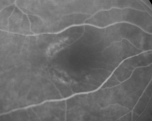 Plaquenil Toxicity with New Symptomatic Scotoma Left Eye
64-year-old female decreased vision OS over the past 2 months. She describes a blurred central scotoma. She has rheumatoid arthritis and is on Plaquenil 200 mg BID for 15 years. She does have yearly visual field tests done with last visual field test performed 3 years ago which was within normal limits OD 20/40-2 OS 20/40-1
