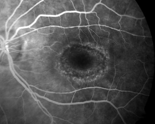 Plaquenil Toxicity with New Symptomatic Scotoma Left Eye
64-year-old female decreased vision OS over the past 2 months. She describes a blurred central scotoma. She has rheumatoid arthritis and is on Plaquenil 200 mg BID for 15 years. She does have yearly visual field tests done with last visual field test performed 3 years ago which was within normal limits OD 20/40-2 OS 20/40-1
