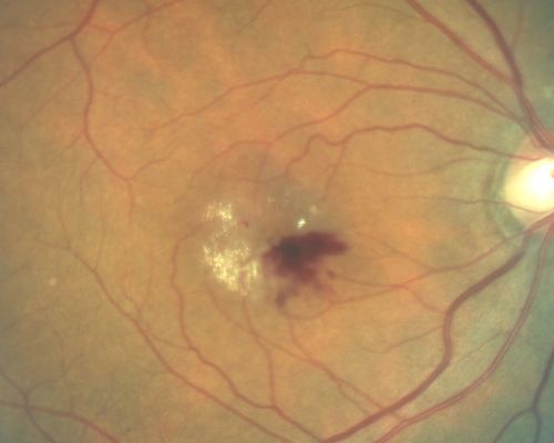 Juxtafoveal Telangiectasis Asymptomatic New Hemorrhage
73-year-old woman has juxtafoveal retinal telangiectasis in both eyes.  The right eye has stage 5 disease.  Her last Avastin treatment in the right eye was in 6 months ago.  The right eye has been the worst of her two eyes for years.

VISUAL ACUITY: Vision OD is 20/200, OS is 20/50.  

Keywords: mactel;juxtafoveal telangiectasis;telangectasia;crystals;hemorrhage