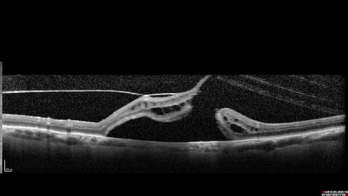 Macular Hole with Limited Retinal Detachment
87 year old female with decreased vision in the left eye for 2 months.  VA 5/200.  Initial three images are pre-op.  Then there is 3 months 6 months and 9 months post-op scans.  VA improved at 1 year to 20/50.  Surgery was done with Brilliant Blue.
