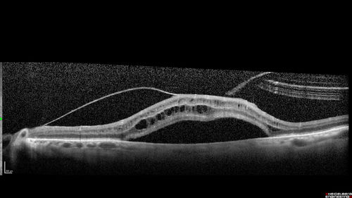 Macular Hole with Limited Retinal Detachment
87 year old female with decreased vision in the left eye for 2 months.  VA 5/200.  Initial three images are pre-op.  Then there is 3 months 6 months and 9 months post-op scans.  VA improved at 1 year to 20/50.  Surgery was done with Brilliant Blue.
