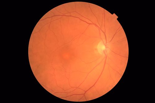 Stage 2-3 Macular Hole - Closed with Vitrectomy and ILM peel with Brilliant blue
68 year old female was 20/100 with macular hole - VA improved to 20/25 post-op.  C3F8 was used
