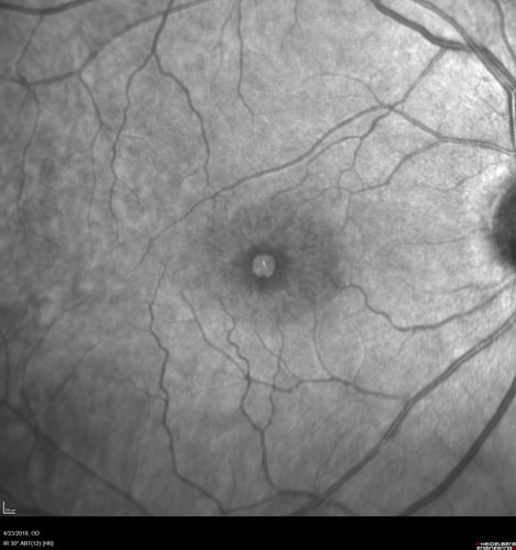 Stage 2-3 Macular Hole - Closed with Vitrectomy and ILM peel with Brilliant blue
68 year old female was 20/100 with macular hole - VA improved to 20/25 post-op.  C3F8 was used
