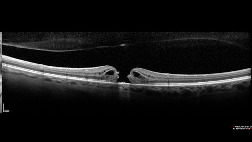 Stage 2-3 Macular Hole - Closed with Vitrectomy and ILM peel with Brilliant blue
68 year old female was 20/100 with macular hole - VA improved to 20/25 post-op.  C3F8 was used
