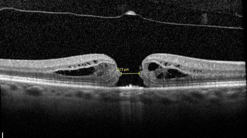 Stage 2-3 Macular Hole - Closed with Vitrectomy and ILM peel with Brilliant blue
68 year old female was 20/100 with macular hole - VA improved to 20/25 post-op.  C3F8 was used
