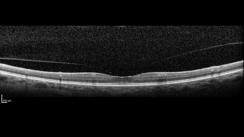 Stage 2-3 Macular Hole - Closed with Vitrectomy and ILM peel with Brilliant blue
68 year old female was 20/100 with macular hole - VA improved to 20/25 post-op.  C3F8 was used

