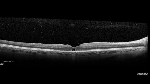 Stage 2-3 Macular Hole - Closed with Vitrectomy and ILM peel with Brilliant blue
68 year old female was 20/100 with macular hole - VA improved to 20/25 post-op.  C3F8 was used
