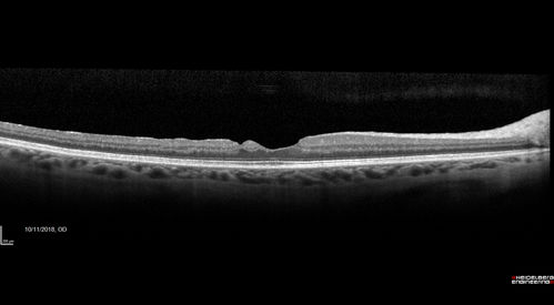 Stage 2-3 Macular Hole - Closed with Vitrectomy and ILM peel with Brilliant blue
68 year old female was 20/100 with macular hole - VA improved to 20/25 post-op.  C3F8 was used
