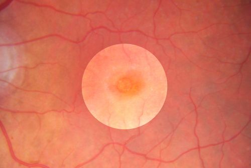 Macular Hole - Asymptomatic - 20/400 Vision
75-year-old woman in a recent exam it was noticed her vision in the left eye had substantially declined.  She is not clear as to when that exactly happened.  She had not noticed a vision change in the left eye.  VISUAL ACUITY:  OD 20/30,  OS 20/400.
