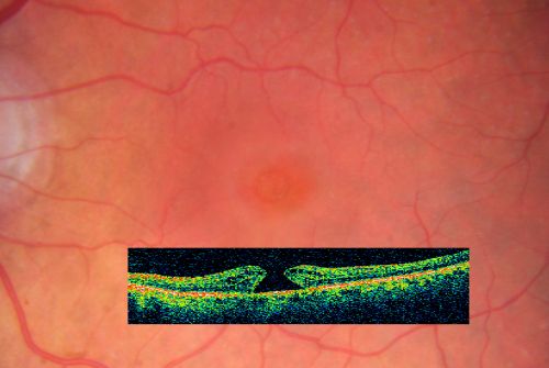 Macular Hole - Asymptomatic - 20/400 Vision
75-year-old woman in a recent exam it was noticed her vision in the left eye had substantially declined.  She is not clear as to when that exactly happened.  She had not noticed a vision change in the left eye.  VISUAL ACUITY:  OD 20/30,  OS 20/400.
