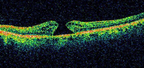 Macular Hole - Asymptomatic - 20/400 Vision
75-year-old woman in a recent exam it was noticed her vision in the left eye had substantially declined.  She is not clear as to when that exactly happened.  She had not noticed a vision change in the left eye.  VISUAL ACUITY:  OD 20/30,  OS 20/400.
