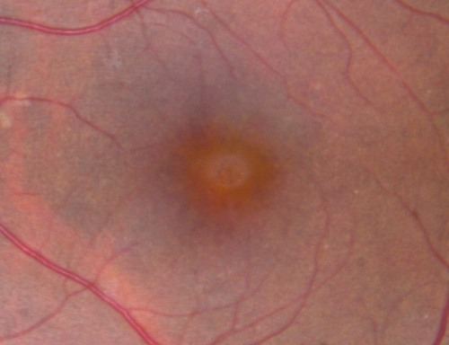 Stage 2 20/100 Idiopathic Macular Hole
62-year-old woman has a macular hole in the left eye.  Her vision is worse than when she was here 1 month ago with a 100 micron hole

VISUAL ACUITY:  OS 20/100.
